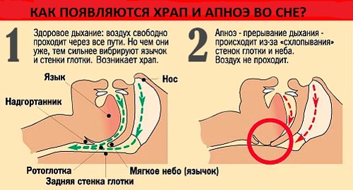 Причины ночной одышки. Одышка при обструктивном апноэ
